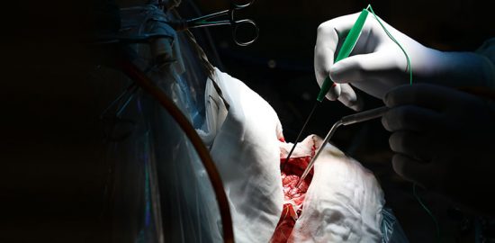 Epilepsi: Prövar nya sätt att mäta minnet under vakenkirurgi