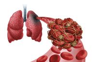 Covid-19 ökar risken för venös tromboembolism och blödning