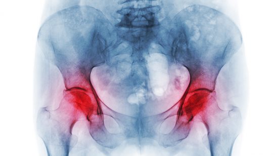 Låg förskrivning av läkemedel för osteoporos inom Sverige