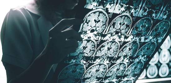 Symtom bör fortsättningsvis vara del av diagnostiken för alzheimer