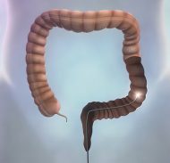 Låg koloskopivolym ökade risken för intervallcancer