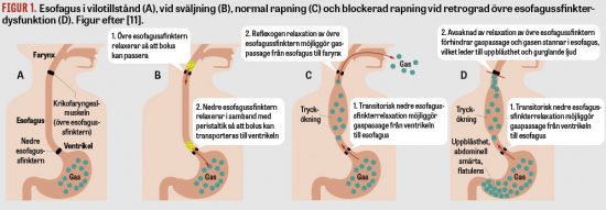 Oförmåga att rapa – retrograd övre esofagussfinkterdysfunktion