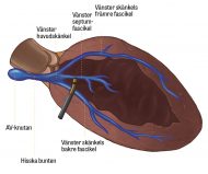 Fysiologisk pacing via vänster skänkel