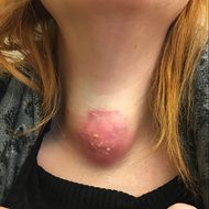 Akut infektiös tyreoidit hos immunsupprimerad kvinna