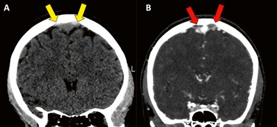 Ny neurologisk entitet: Intrakraniell trombos i venösa sjöar