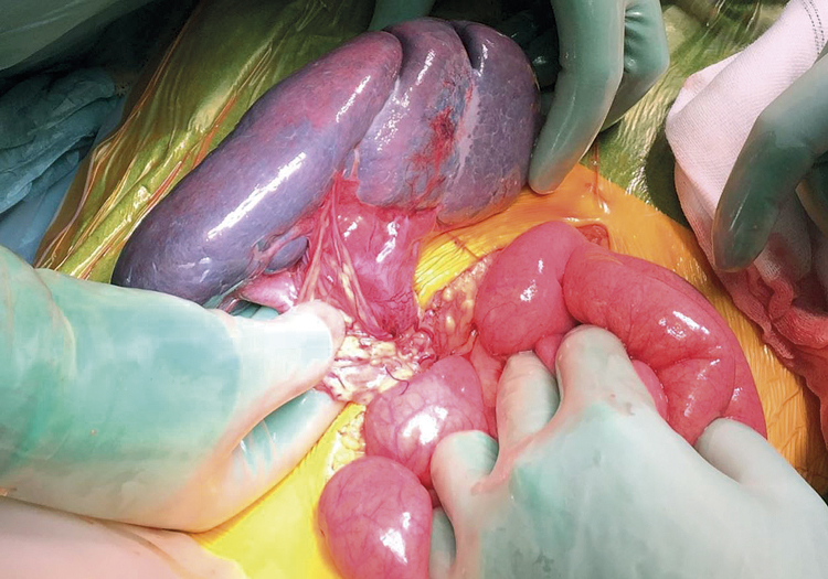 Vandrande mjälte – ovanlig men viktig differentialdiagnos vid akut buksmärta hos barn