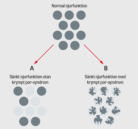 Krympt por-syndrom – ett nyupptäckt syndrom med hög prevalens och mortalitet